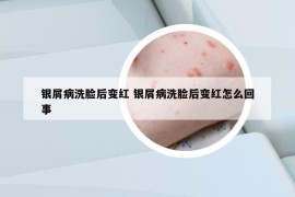銀屑病洗臉后變紅 銀屑病洗臉后變紅怎么回事