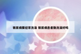 銀屑病要經(jīng)常洗澡 銀屑病患者勤洗澡好嗎