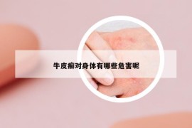 牛皮癬對(duì)身體有哪些危害呢