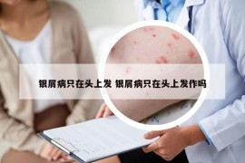 銀屑病只在頭上發(fā) 銀屑病只在頭上發(fā)作嗎