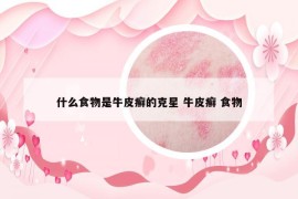 什么食物是牛皮癬的克星 牛皮癬 食物