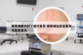銀屑病都快好了遇冷復(fù)發(fā) 銀屑病治愈后復(fù)發(fā)可能性多大