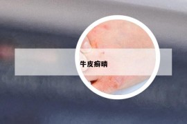 牛皮癬晴