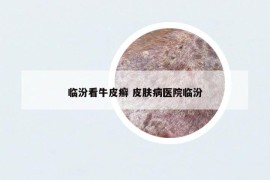 臨汾看牛皮癬 皮膚病醫(yī)院臨汾
