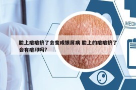 臉上痘痘擠了會變成銀屑病 臉上的痘痘擠了會有痘印嗎?
