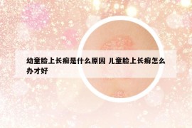 幼童臉上長癬是什么原因 兒童臉上長癬怎么辦才好