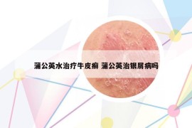 蒲公英水治療牛皮癬 蒲公英治銀屑病嗎