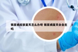 銀屑病皮膚夏天怎么辦呀 銀屑病夏天會自愈嗎