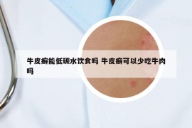 牛皮癬能低碳水飲食嗎 牛皮癬可以少吃牛肉嗎
