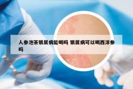 人參泡茶銀屑病能喝嗎 銀屑病可以喝西洋參嗎