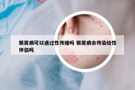 銀屑病可以通過性傳播嗎 銀屑病會(huì)傳染給性伴侶嗎