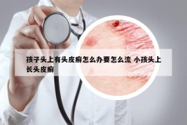 孩子頭上有頭皮癬怎么辦要怎么流 小孩頭上長(zhǎng)頭皮癬