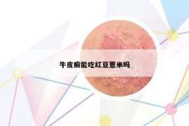 牛皮癬能吃紅豆薏米嗎