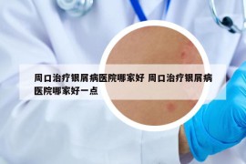 周口治療銀屑病醫(yī)院哪家好 周口治療銀屑病醫(yī)院哪家好一點