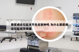銀屑病會引起關(guān)節(jié)處皮膚腫嗎 為什么銀屑病會引起關(guān)節(jié)疼痛