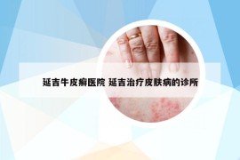 延吉牛皮癬醫(yī)院 延吉治療皮膚病的診所