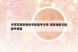 尋常型銀屑病會導致指甲分離 銀屑病能引起指甲病變