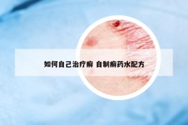 如何自己治療癬 自制癬藥水配方
