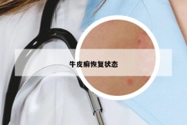 牛皮癬恢復(fù)狀態(tài)