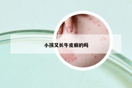 小孩又長牛皮癬的嗎