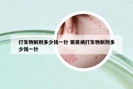 打生物制劑多少錢一針 銀屑病打生物制劑多少錢一針