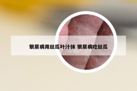 銀屑病用絲瓜葉汁抹 銀屑病吃絲瓜