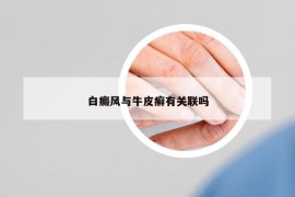 白癜風(fēng)與牛皮癬有關(guān)聯(lián)嗎