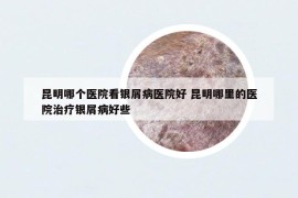 昆明哪個醫(yī)院看銀屑病醫(yī)院好 昆明哪里的醫(yī)院治療銀屑病好些