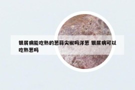 銀屑病能吃熟的蔥蒜尖椒嗎洋蔥 銀屑病可以吃熟蔥嗎