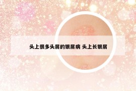 頭上很多頭屑的銀屑病 頭上長(zhǎng)銀屑