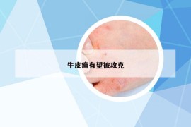 牛皮癬有望被攻克