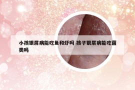 小孩銀屑病能吃魚和蝦嗎 孩子銀屑病能吃菌類嗎