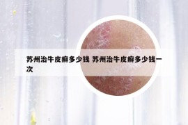 蘇州治牛皮癬多少錢 蘇州治牛皮癬多少錢一次