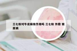 三七粉對(duì)牛皮癬有作用嗎 三七粉 外敷 銀屑病