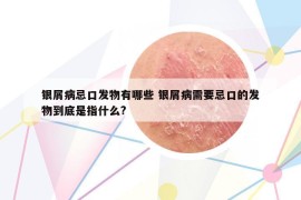 銀屑病忌口發(fā)物有哪些 銀屑病需要忌口的發(fā)物到底是指什么?