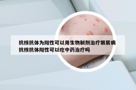 抗核抗體為陽(yáng)性可以用生物制劑治療銀屑病 抗核抗體陽(yáng)性可以吃中藥治療嗎