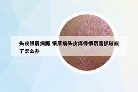 頭皮銀屑病抓 銀屑病頭皮癢得很厲害抓破皮了怎么辦
