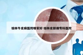 榆林牛皮癬醫(yī)院哪家好 榆林皮膚病專(zhuān)科醫(yī)院