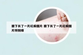 腋下長了一片紅癬圖片 腋下長了一片紅癬圖片特別癢