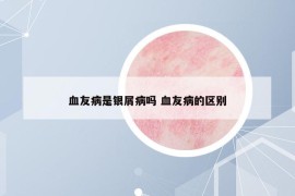 血友病是銀屑病嗎 血友病的區(qū)別