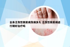 全身泛發(fā)性銀屑病發(fā)病多久 泛發(fā)性銀屑病進(jìn)行期好治療嗎