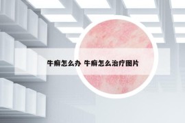 牛癬怎么辦 牛癬怎么治療圖片