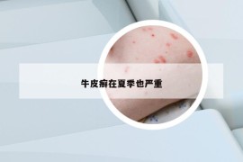 牛皮癬在夏季也嚴(yán)重