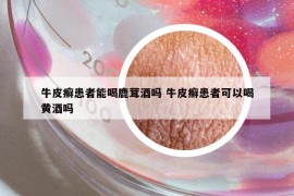 牛皮癬患者能喝鹿茸酒嗎 牛皮癬患者可以喝黃酒嗎