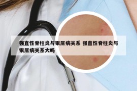 強(qiáng)直性脊柱炎與銀屑病關(guān)系 強(qiáng)直性脊柱炎與銀屑病關(guān)系大嗎
