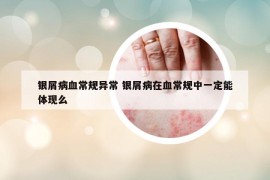 銀屑病血常規(guī)異常 銀屑病在血常規(guī)中一定能體現(xiàn)么