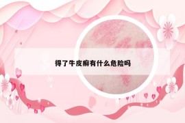 得了牛皮癬有什么危險嗎