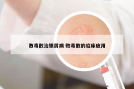 敗毒散治銀屑病 敗毒散的臨床應(yīng)用