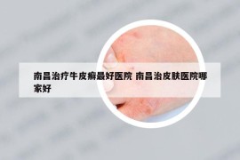 南昌治療牛皮癬最好醫(yī)院 南昌治皮膚醫(yī)院哪家好