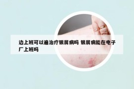 邊上班可以遍治療銀屑病嗎 銀屑病能在電子廠上班嗎